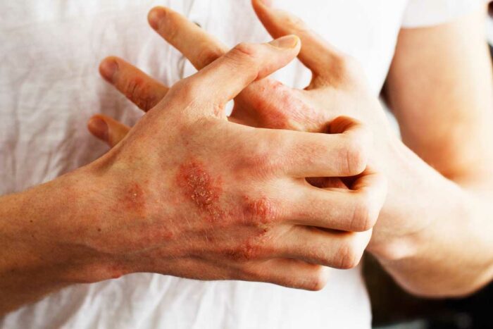 Mains homme eczema