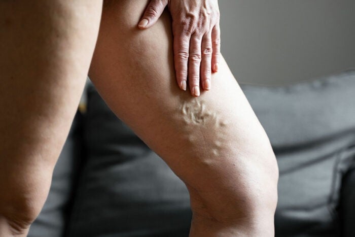Femme souffrant de phlébite sur sa jambe gauche