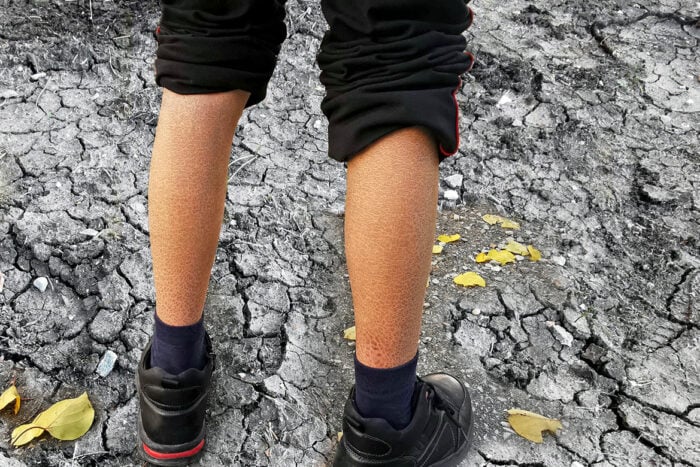 Homme qui souffre d'ichtyose sur les jambes