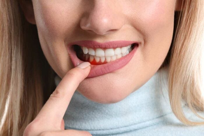 femme montrant inflammation de la gencive gingivite