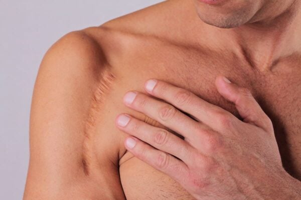 cicatrice cure thermale