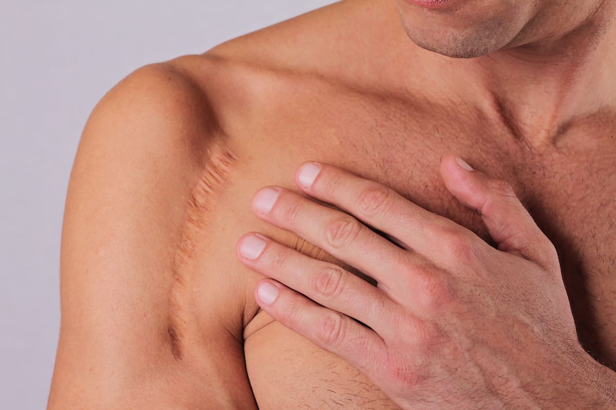 cicatrice cure thermale
