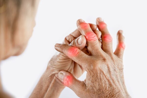 Femme souffrant d'arthrose des mains