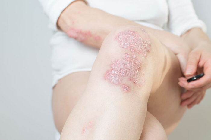 Femme souffrant de psoriasis sur les genoux et aux coudes