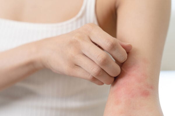 Femme souffrant d'eczéma autopique au niveau du bras