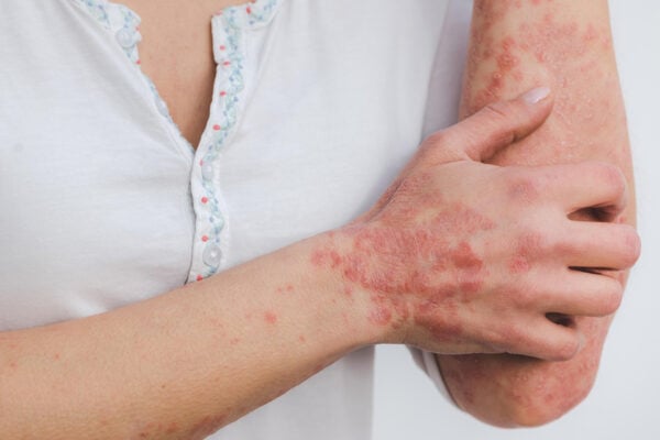 Remboursement de la cure thermale psoriasis ©Pixabay - Eszter Miller